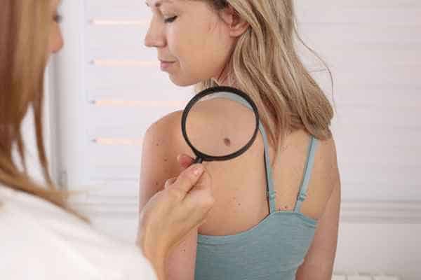 What Are Traditional Skin Lesion Removal Methods Kingston upon Thames?