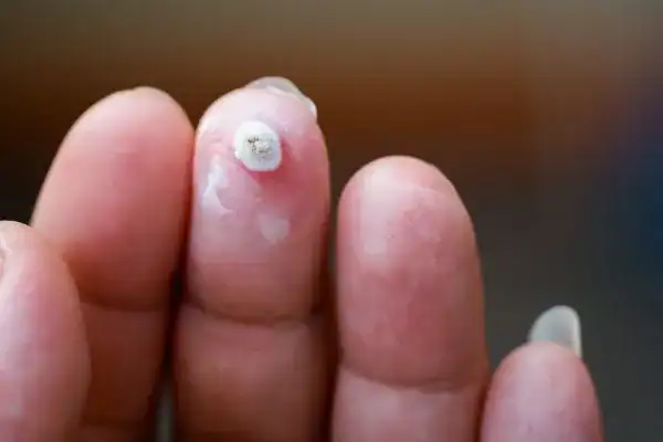 Image of white wart before cryopen treatment Kingston upon Thames