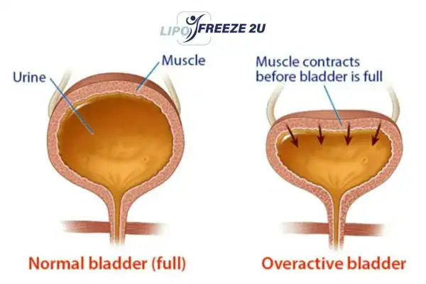 diagram of overactive bladder treatment Kingston upon Thames