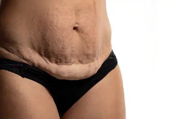 loose skin after weight loss injections Kingston upon Thames