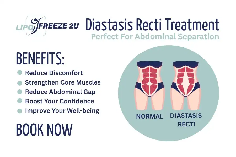 Benefits of body toning treatment Kingston upon Thames for Diastasis recti