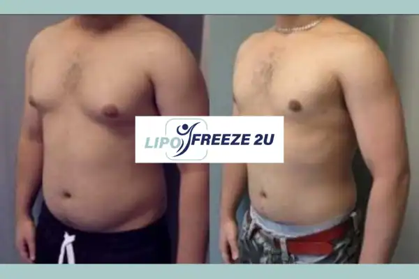 How Long Does It Take to See Results Kingston upon Thames?