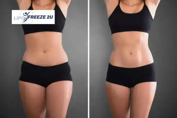 How Can LIPO FREEZE 2U Support Your Post-Pregnancy Body Recovery Kingston upon Thames?