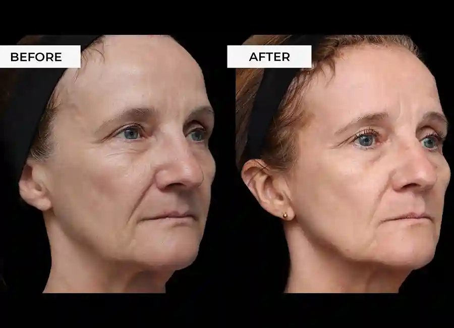 How Many RF Microneedling Sessions Will You Need to See a Difference Kingston upon Thames?
