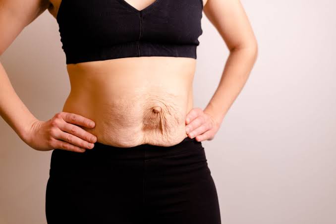 Is Surgery Really the Only Way to Repair Diastasis Recti Kingston upon Thames?
