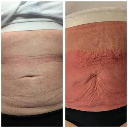 How Does RF Microneedling Improve Crepey, Thin and Uneven Skin Texture Kingston upon Thames?