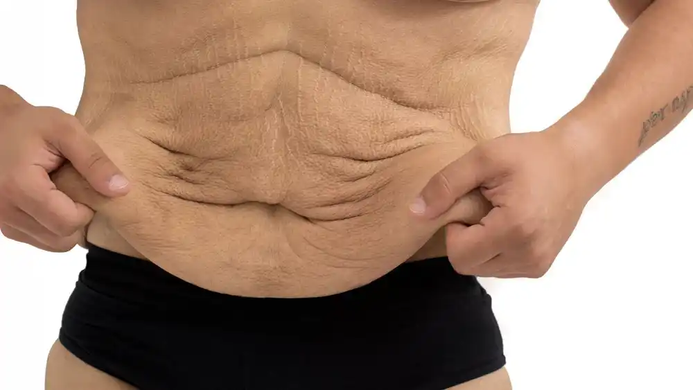 RF Microneedling for Loose Skin: How Can It Help Tighten and Reshape the Skin Kingston upon Thames?